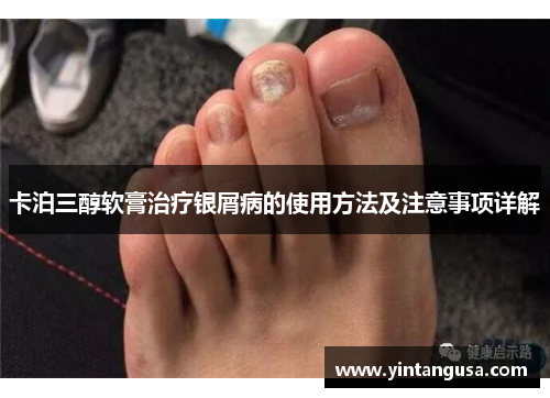 卡泊三醇软膏治疗银屑病的使用方法及注意事项详解